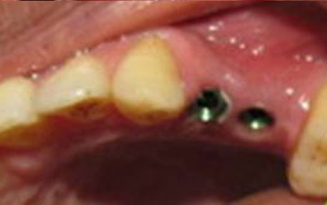 Implant Treatment For Multiple Teeth