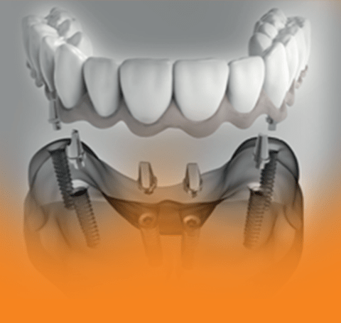 braces_and_aligner icon