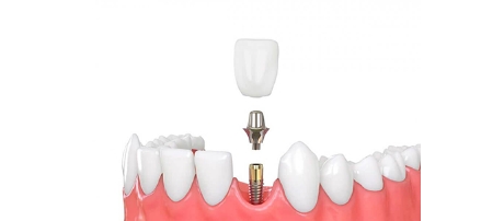 types of Dental Implants