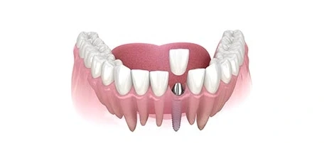 types of Dental Implants