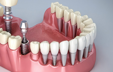 teeth-img