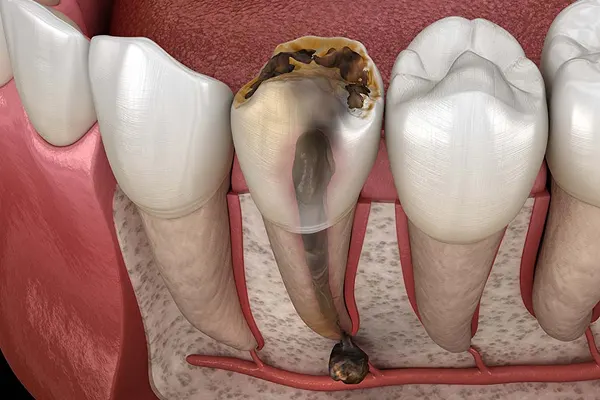 Pus or boil near tooth