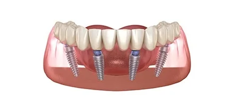 types of Dental Implants