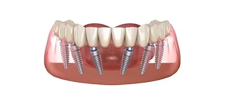 types of Dental Implants