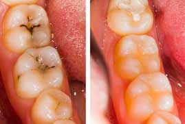 Tooth Filling Treatment