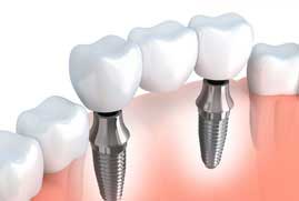 tooth implant procedure