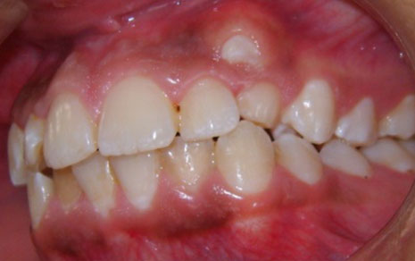 teeth braces cost in delhi