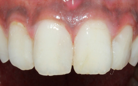 Tooth Cavity Treatment
