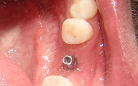 dental implants new delhi