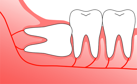 Wisdom Tooth Removal: Age, Process, & Aftercare!