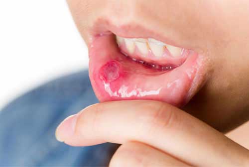  mouth ulcers