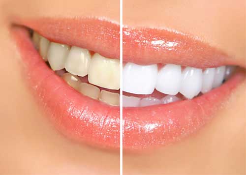Whitening price teeth The Cost