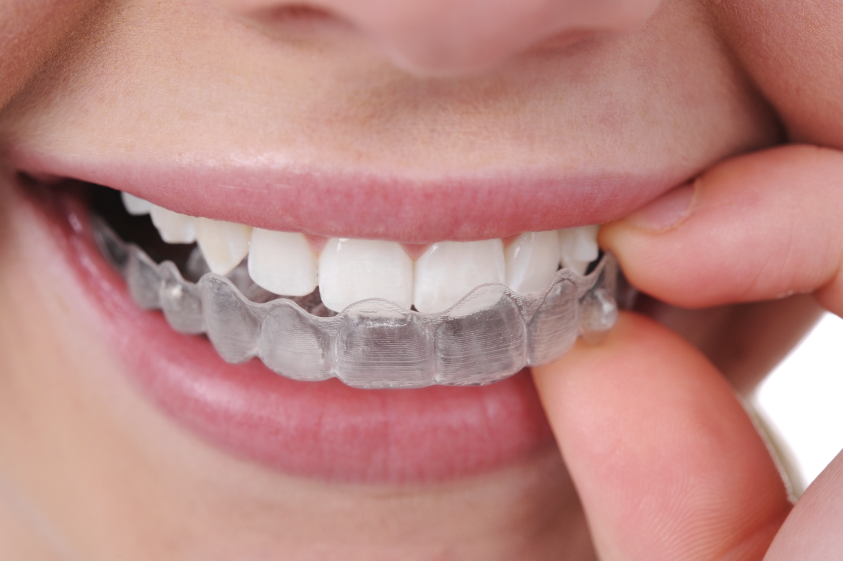 Clear Aligners Invisible Braces Invisible Aligners Treatment Cost