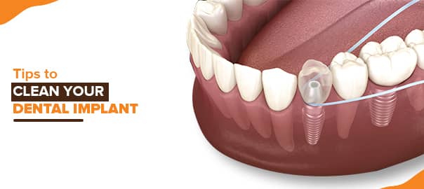 Dental Tips to clean your dental implant
