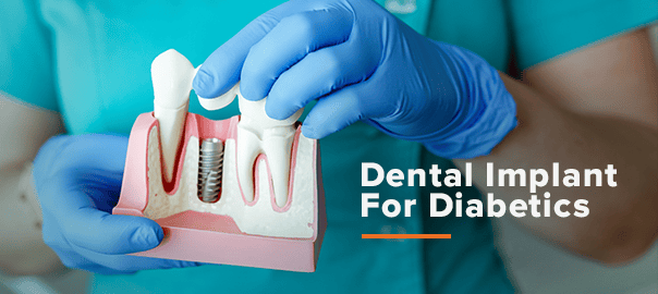 Dental Implant For Diabetics