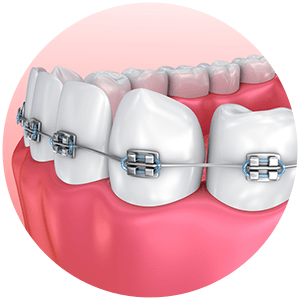 Dental Braces