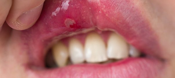 Mouth-Ulcers