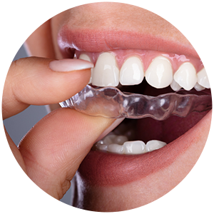 Aligners