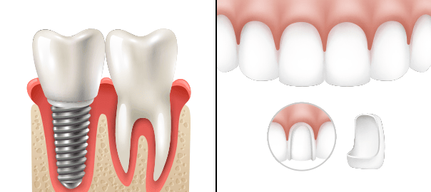 Dental Implants vs Veneers