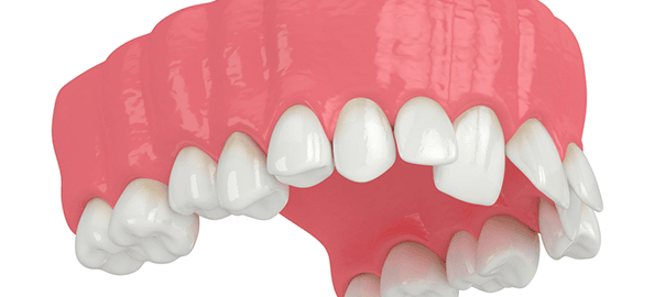 Causes of the Misaligned Teeth