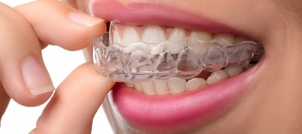 Teeth Grinding (Bruxism) Causes & Treatments - Clove Dental
