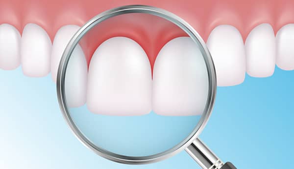 6 Common Gum Disease Myths