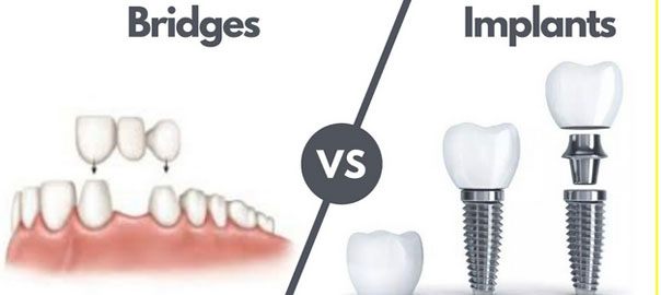 Dental bridge for missing teeth