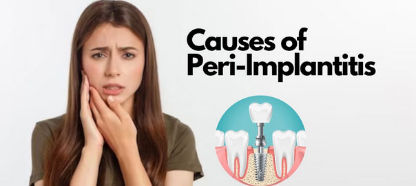 Causes of peri-implantitis