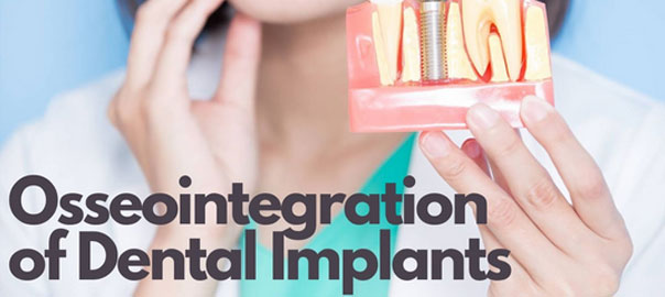 Osseointegration process of dental implants Bone bonding in dental implantation Integration of dental implant with jawbone Implant stability through osseointegration Successful osseointegration of implants