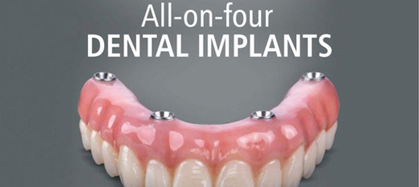 All-on-4 implant-supported dentures
