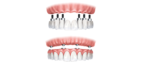 Implant Supported Crown