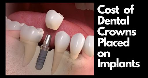 Cost of Dental Crowns Placed on Implants