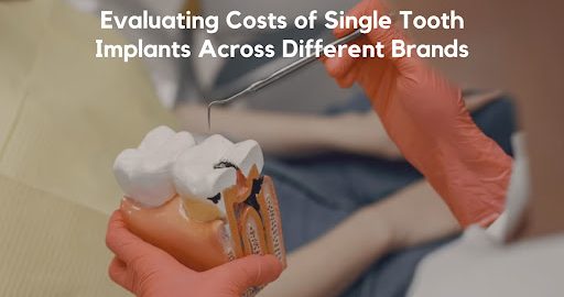 Comparison of Single Tooth Implant Costs of Various Brands