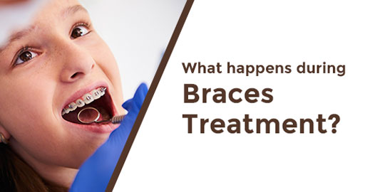 What to Expect During Braces Treatment