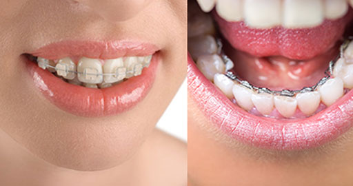 types of braces for teeth