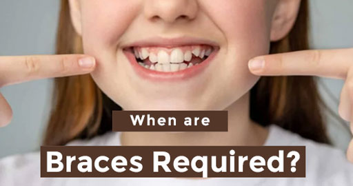use of braces