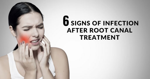 6 Signs Of Infection After Root Canal Treatment