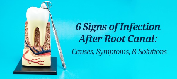 6 signs of Infection After Root Canal