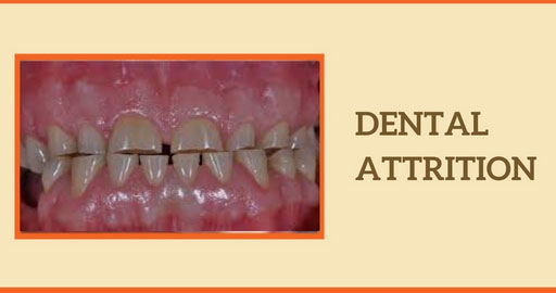 Dental Attrition