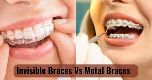 types of braces