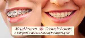 Metal Braces vs. Ceramic Braces