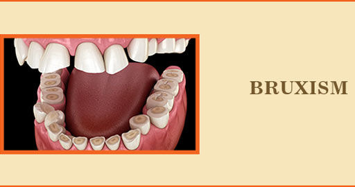 Bruxism: Symptoms Causes and Treatment