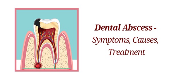 dental abscess