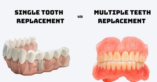single teeth implant cost