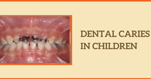 Read About Dental Caries in Children