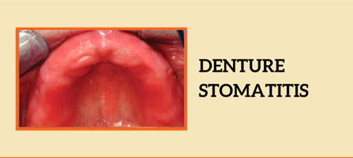 Denture Stomatitis