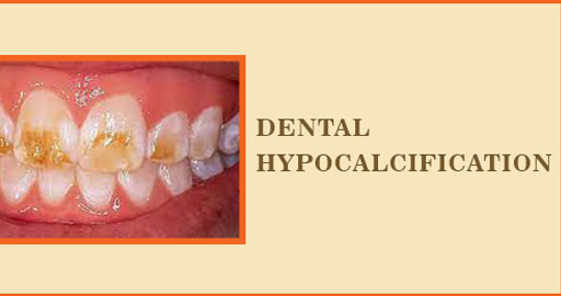 Dental Hypocalcification Symptoms Causes Treatment