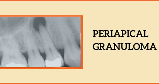 Dental Granuloma