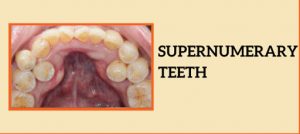 Supernumerary Teeth