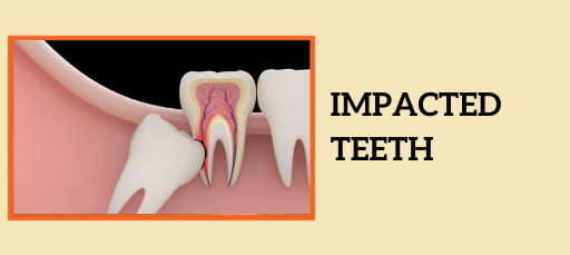 Wisdom Tooth Impaction